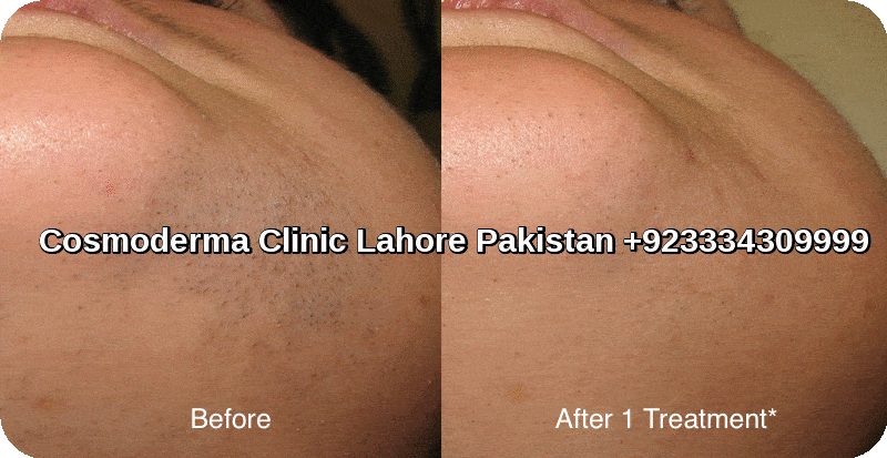 Laser hair removal clinic Lahore