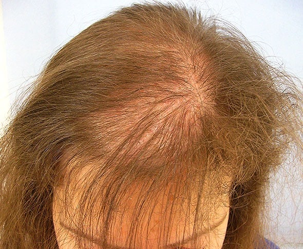 Hair loss treatment for women- Lahore