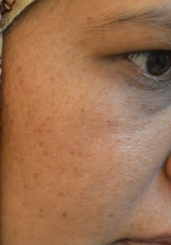 after-black-spots-laser-treatment-lahore