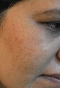 black-spots-laser-treatment-lahore