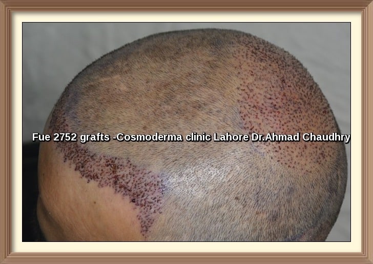 Fue hair transplant 2752 grafts before and after photos Lahore