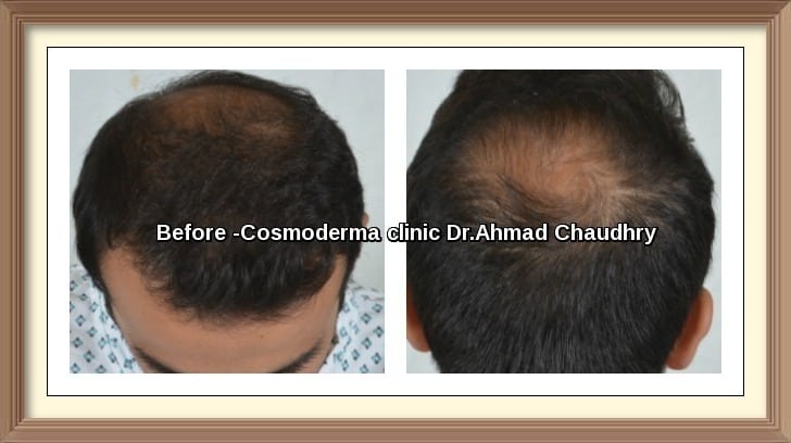 Hair Restoration before after 2752 grafts Lahore Pakistan