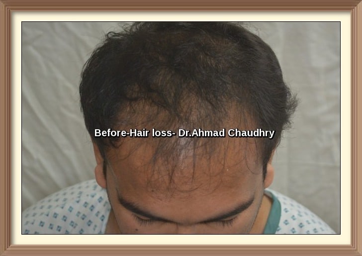 Hair loss treatment Lahore