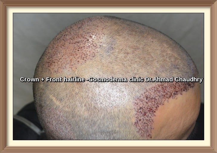 Micro fue hair transplant 2752 grafts before after pictures lahore results