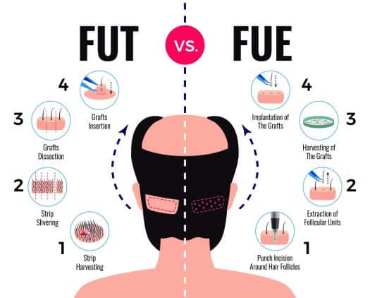 what-is-fue-Vs-FUT-difference