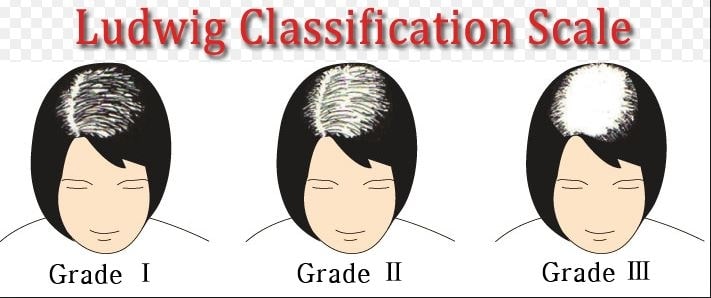 Female pattern baldness classification
