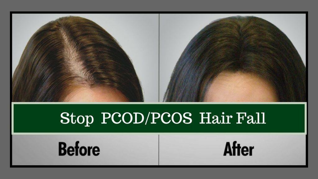 hair loss polycystic treatment Lahore Pakistan
