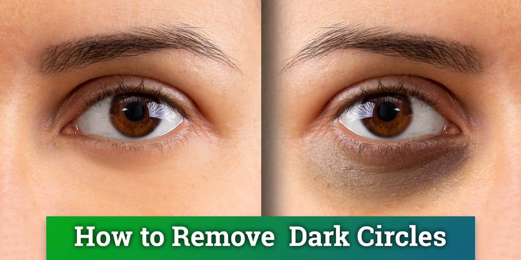 laser treatment for dark circles under eyes