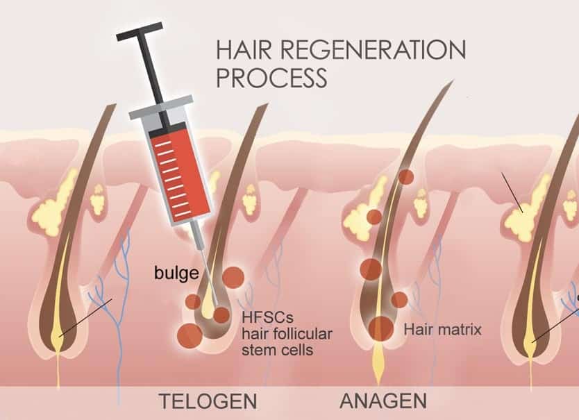 Hair regrowth injection Lahore