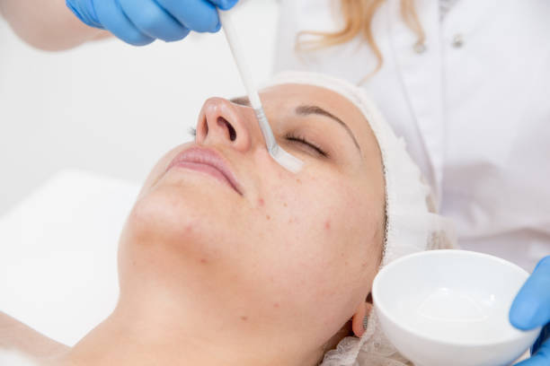 Acne pimples chemical peel treatment Lahore