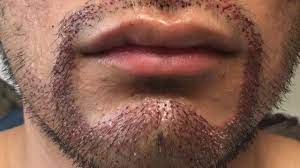 Facial hair surgery Lahore