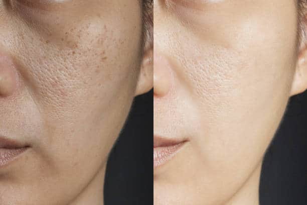 Open pores -pigmentation peeling Lahore