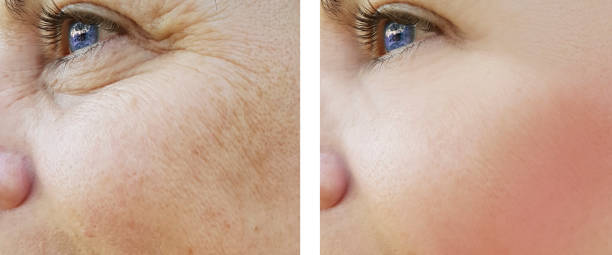Wrinkles and pigmentation treatment