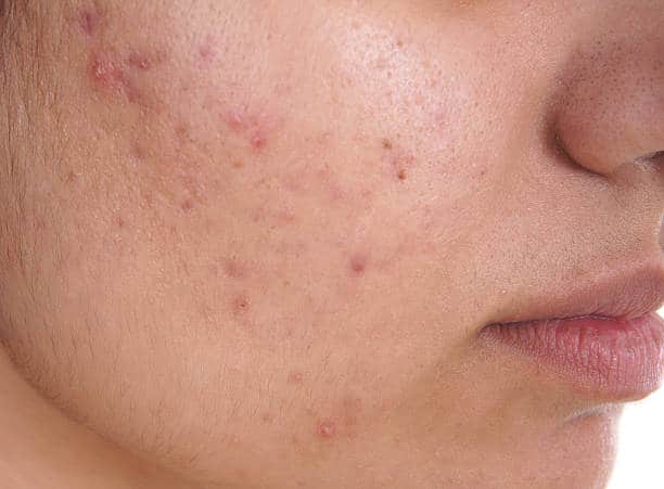 pimples spots