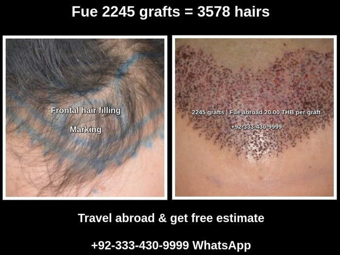 Fue 2245 grafts hair transplant before after photos Lahore