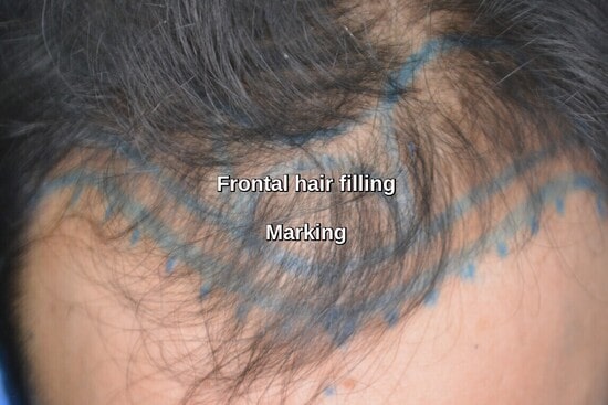 frontal hair loss