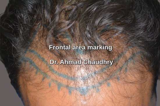 Hair restoration specialist clinic Faisalabad