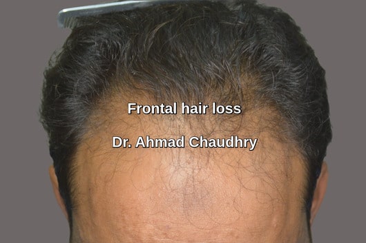 Hair transplant Faisalabad patient