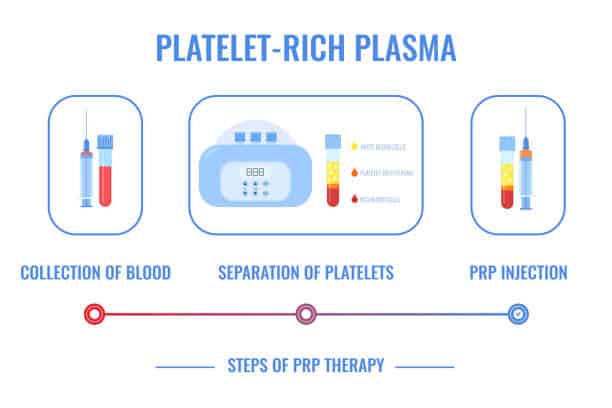 PRP therapy steps