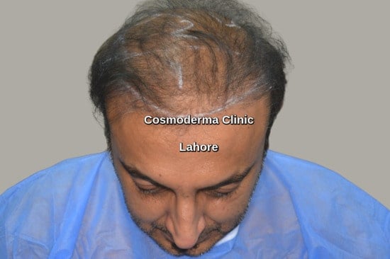 poor hair transplant results repair