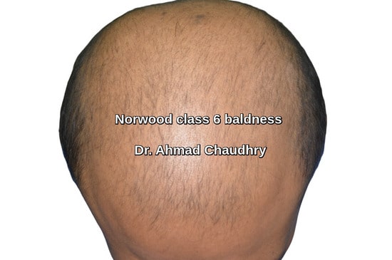 Advance baldness treatment before