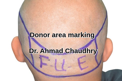 Fue donor area marking before extraction