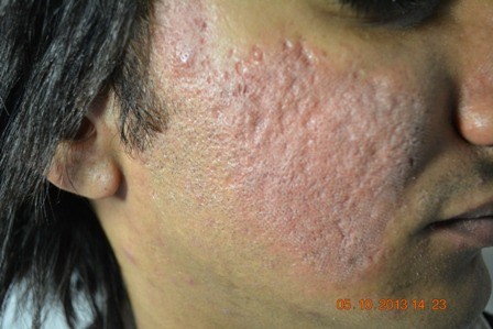 Laser skin Resurfacing Lahore