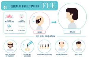 Hair transplantation Italy
