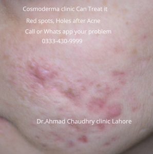 chemical-peel-treatment-clinic-lahore
