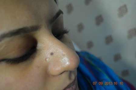 Laser mole removal in Lahore