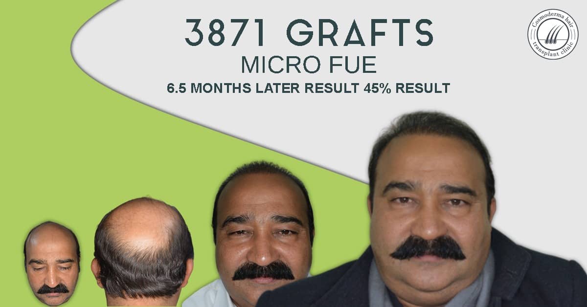 Advance-baldness-treatment-in-Lahore