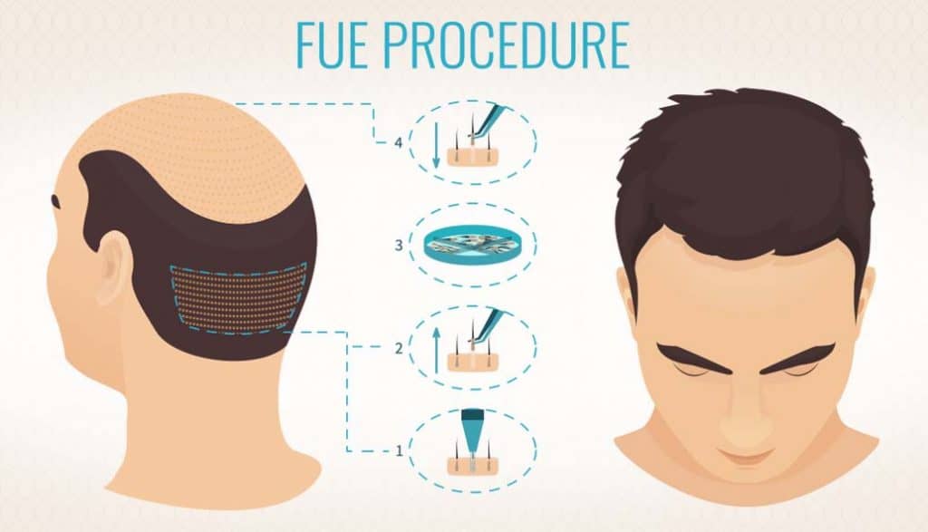 what-is-fue-hair-transplant