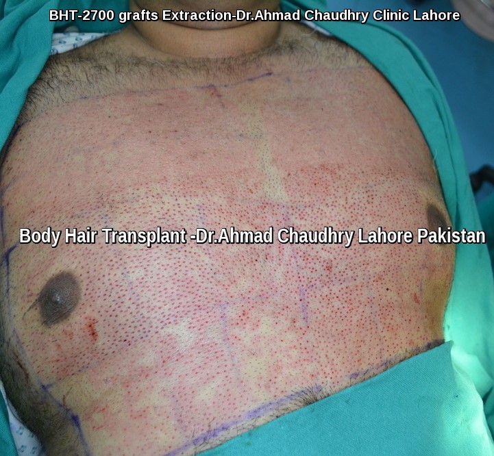 Body hair transplant to head Pakistan - Dr. Ahmad Chaudhry | Call us now
