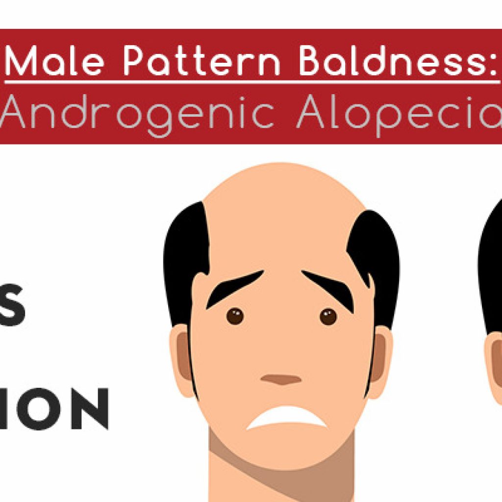 Male pattern baldness treatment in Lahore