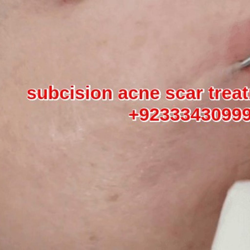 Subcision acne scar treatment lahore