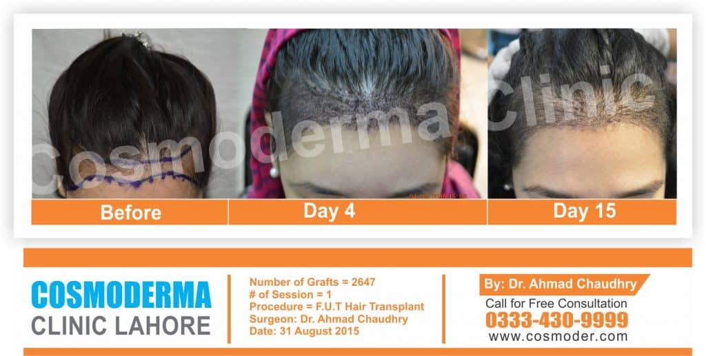 Female hair restoration Lahore