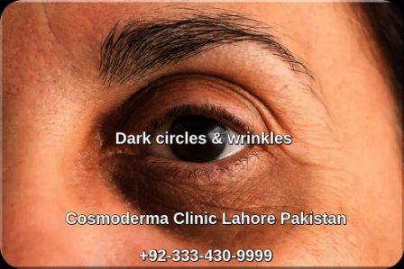 Black circles treatment Lahore Pakistan