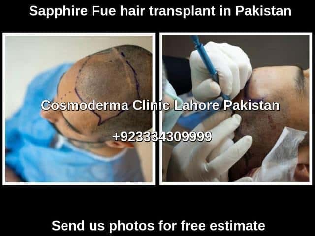 4000 grafts hair transplant cost Lahore Pakistan