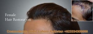 women hair transplant Lahore Pakistan banner