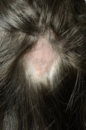 Scarring Alopecia treatment Lahore