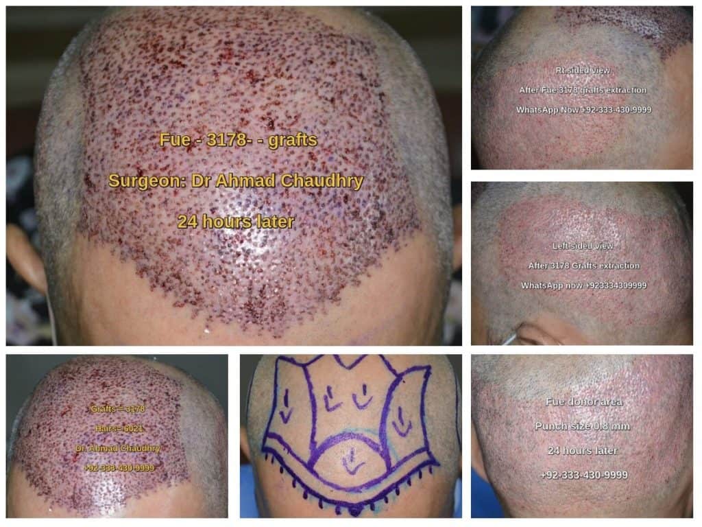 3178 grafts before after photos Lahore Pakistan