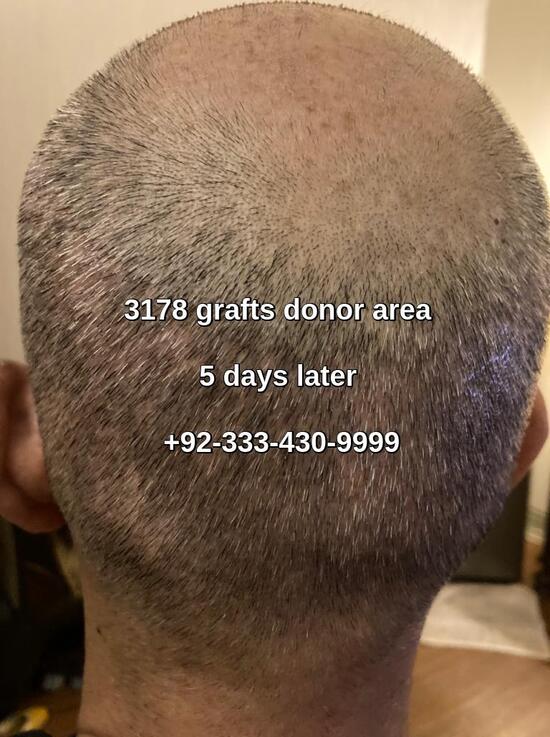 5 days later Fue donor area hair regrowth