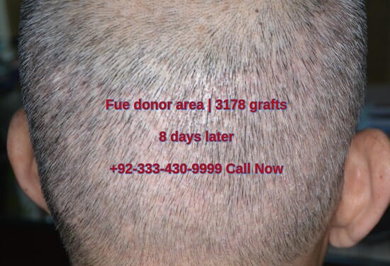 8 days later Fue donor area regrowth