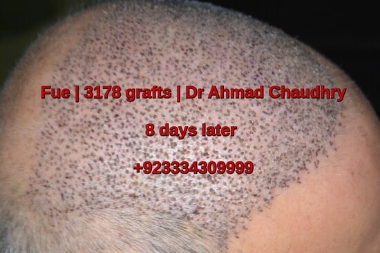 8 days later fue hair transplant recipient area