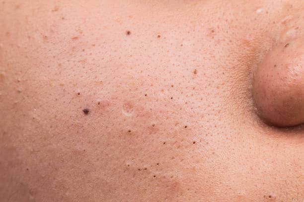 Blackheads treatment clinic Lahore 