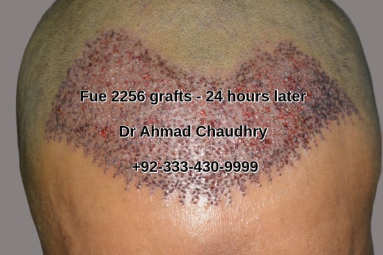 Fue hair restoration 2256 grafts