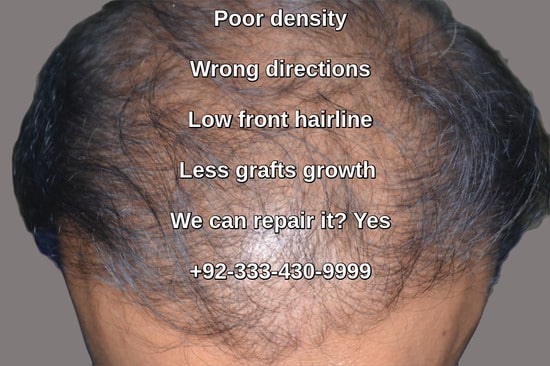 Hair transplant fail | Fixing poor hair restoration results Lahore