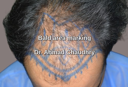 Baldness area marking Sheikhupura patient