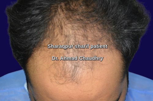 Hair transplant Sharaqpur Sharif patient