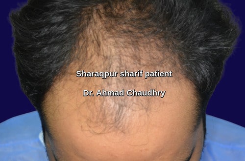 Hair transplant Sharaqpur Sheikhupura patient | 2876 grafts photos Hair transplant Sharaqpur Sheikhupura patient | 2876 grafts photos